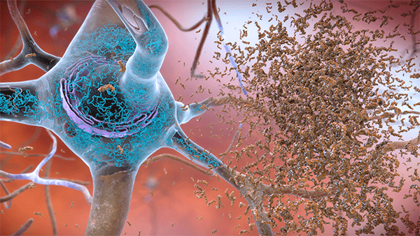 Illustration of beta-amyloid and tau in the brain of Alzheimer's patients.